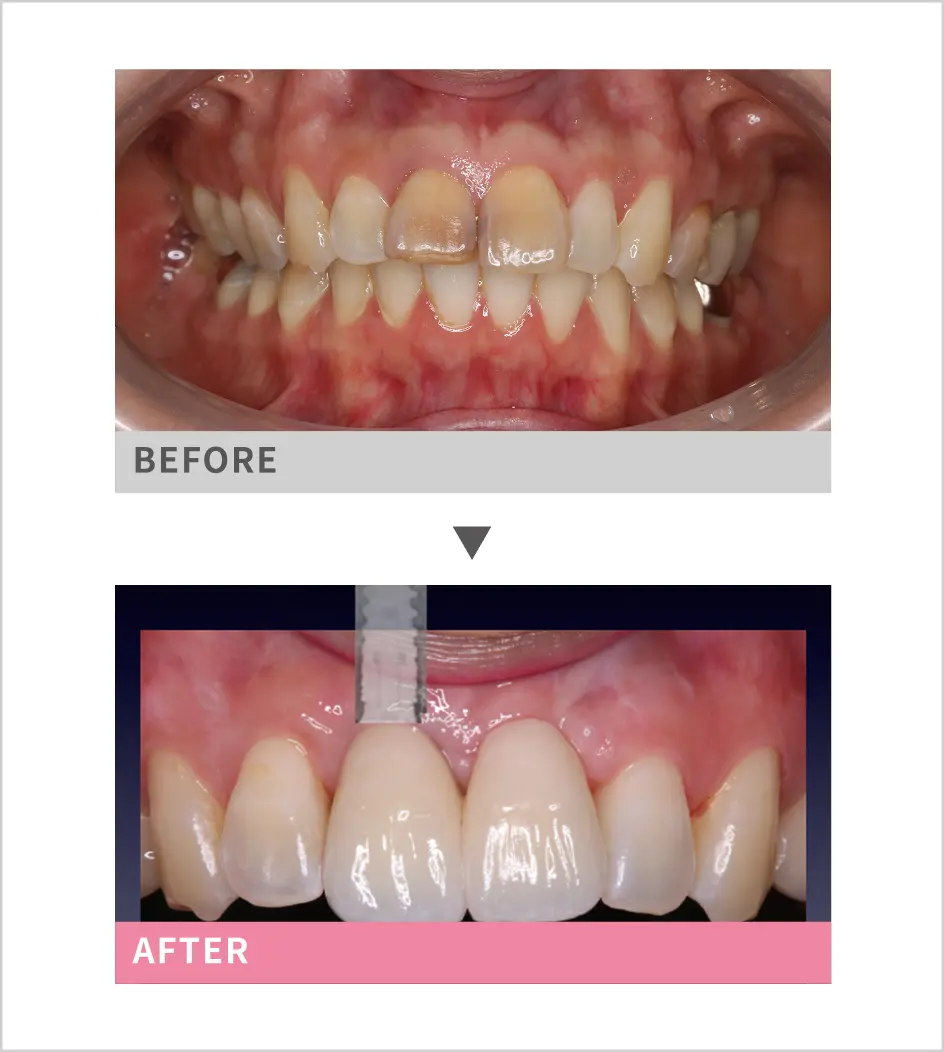 インプラントbefore after画像