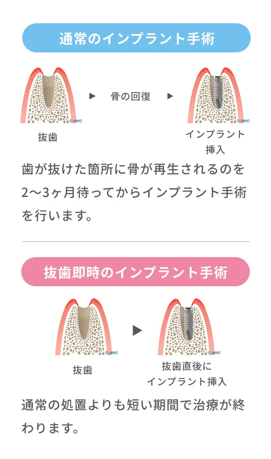 通常のインプラントと即時インプラントの違いを比較した画像