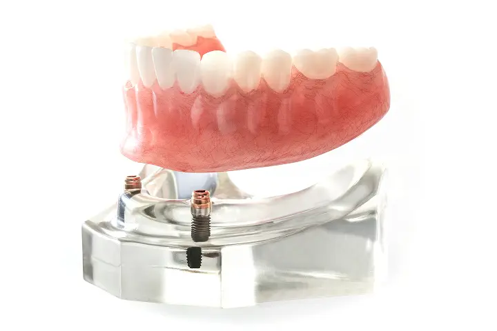 インプラントオーバーデンチャーの画像