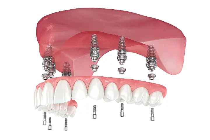 固定性インプラントブリッジの画像