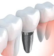 インプラントを歯に埋め込む様子